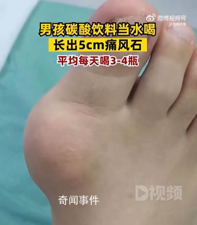 男孩1天4瓶饮料长5厘米痛风石 目前患者恢复良好