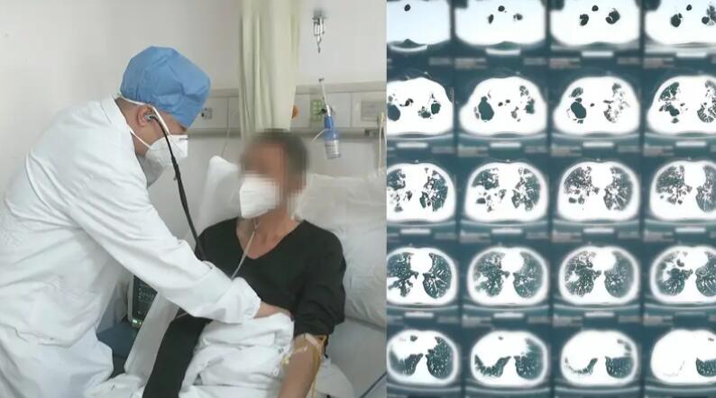 男子每天抽10包烟 双肺千疮百孔